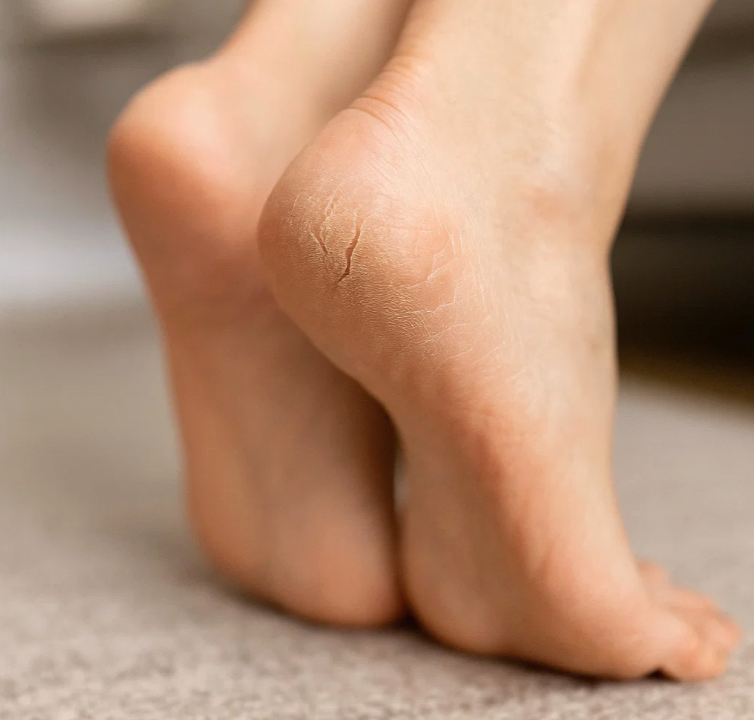 Spruckna hälar på vintern: orsaker, rutin och lindring