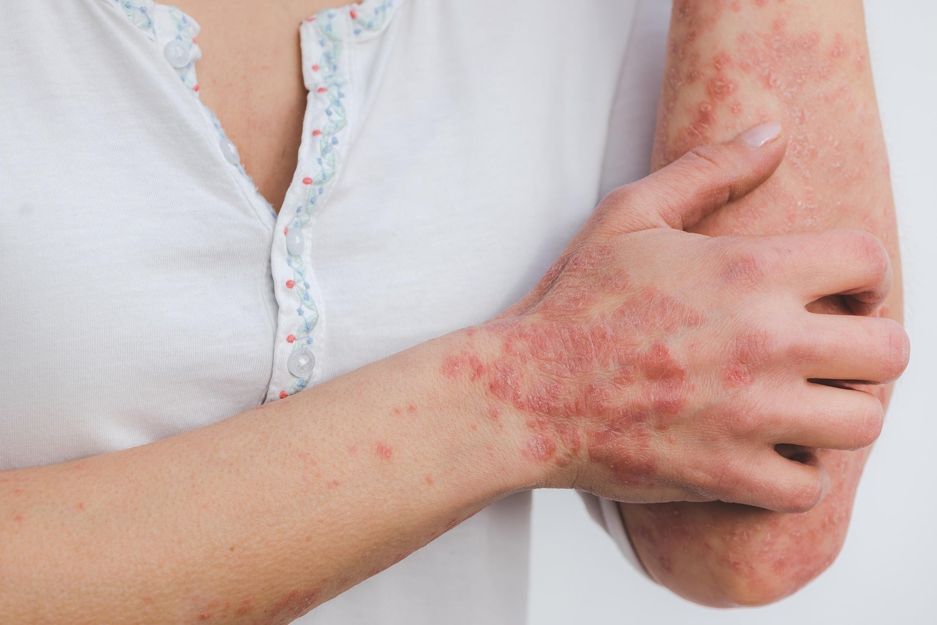 Psoriasisbehandling: Mild vardagsrutin steg-för-steg