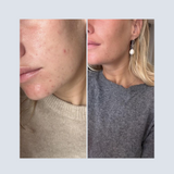 BIOpH Acne prone hela rutinen